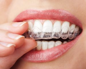 Invisalign, dentist, clear aligners