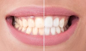 teeth whitening brandon fl