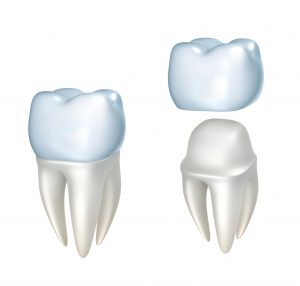Same Day CEREC Dental Crowns Illustration