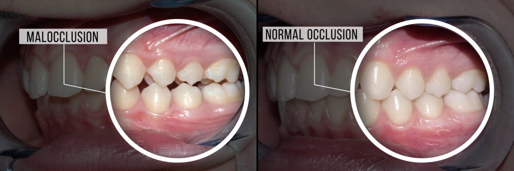 Class 1 malocclusion image