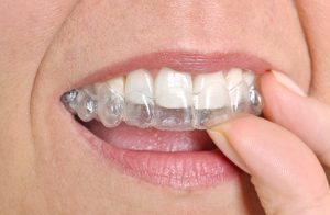 Woman Applying Invisalign Clear Aligners