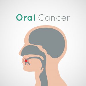 Oral Cancer Screening - Saratoga Springs, NY