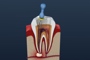 Illustration Of Root Canal Treatment
