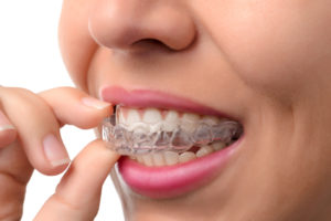 Woman putting in invisalign clear aligner