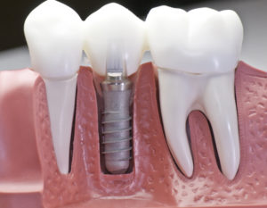 dental implants raleigh nc 