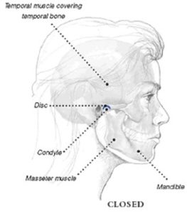Sideview drawing of man's face showing pain points related to TMJ