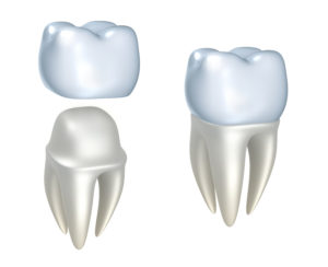 dental crowns spokane wa